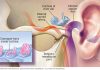 Tinnitus