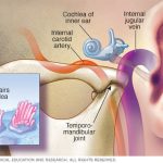 Tinnitus