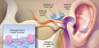 Tinnitus