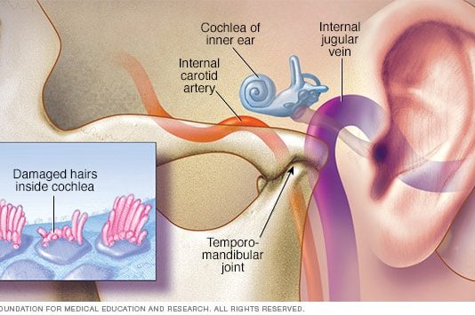 Tinnitus