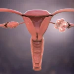 PCOS: Podpora léčby životním stylem
