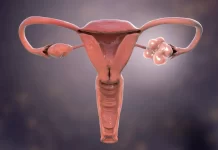 PCOS: Podpora léčby životním stylem