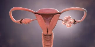 PCOS: Podpora léčby životním stylem