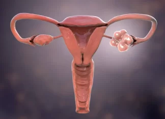 PCOS: Podpora léčby životním stylem