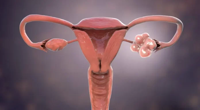 PCOS: Podpora léčby životním stylem