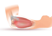 Tenisový loket: Jak ho léčit a co ho způsobuje? Tenisový loket: Jak ho léčit a co ho způsobuje?